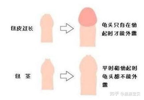 女人割完皮包后的恢復(fù)之路，女人割皮包后的恢復(fù)與重塑之路