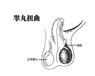 睪丸扭轉(zhuǎn)的癥狀及其影響，睪丸扭轉(zhuǎn)的癥狀與影響概述