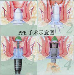 吻合器手術(shù)后恢復(fù)圖，了解恢復(fù)過程，促進(jìn)健康復(fù)原，吻合器手術(shù)后恢復(fù)全圖解，了解恢復(fù)過程，助力健康復(fù)原