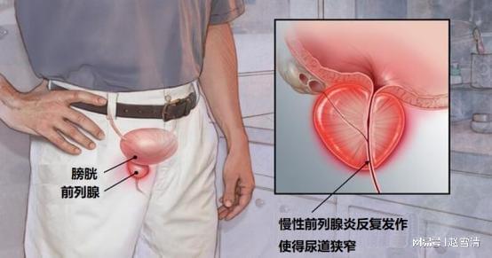 跑步治愈了我的前列腺問題，一種健康生活的力量，跑步治愈前列腺問題，健康生活的力量之源