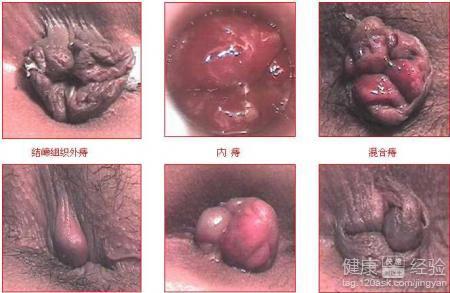 偏方治痔瘡，一種古老而有效的自然療法，古老偏方治療痔瘡的自然療法，有效且傳承至今