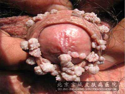 尖銳濕尤，深入了解其影響與后果，尖銳濕尤，全面解析其影響與后果